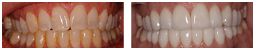 Southington Dentistry | Clenching and Grinding, Southington Veneers and Dental Crowns
