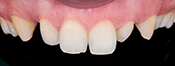 Southington Dentistry | Dental Fillings, Dental Bridges and Dental Emergencies