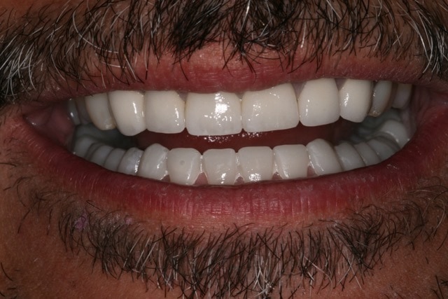 Southington Dentistry | Southington Veneers, Clenching and Grinding and Dental Crowns