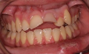 Southington Dentistry | Clenching and Grinding, Dental Crowns and Gum Disease