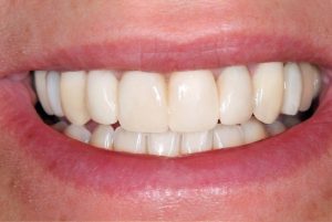 Southington Dentistry | Dental Bridges, Teeth Whitening and Jaw Pain TMJ