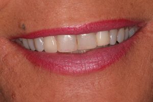 Southington Dentistry | Clenching and Grinding, Dental Extractions in Southington and Dental Crowns