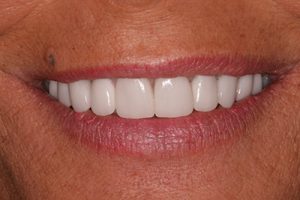 Southington Dentistry | Dental Emergencies, Jaw Pain TMJ and Plantsville Sixth Month Smiles