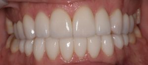 Southington Dentistry | Sedation Dentistry, Contouring and Bonding and Cosmetic Dentistry