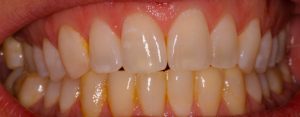 Southington Dentistry | Dental Bridges, Dental Crowns and Drill-Less Dentistry