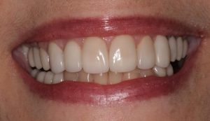 Southington Dentistry | Jaw Pain TMJ, Drill-Less Dentistry and Dental Crowns