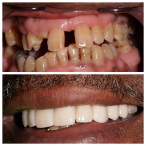 Southington Dentistry | Dental Fillings, Jaw Pain TMJ and Root Canals