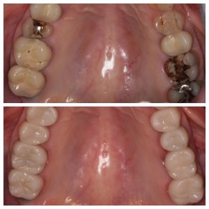 Southington Dentistry | Plantsville Dental Implants, Clenching and Grinding and Contouring and Bonding