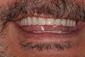 Southington Dentistry | Dental Emergencies, Sedation Dentistry and Drill-Less Dentistry