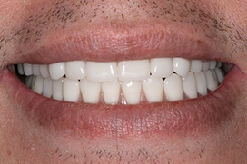 Southington Dentistry | Root Canals, Dental Crowns and Gum Disease